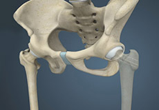 Fracture Repair