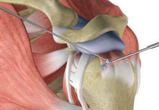 Fracture Surgery
